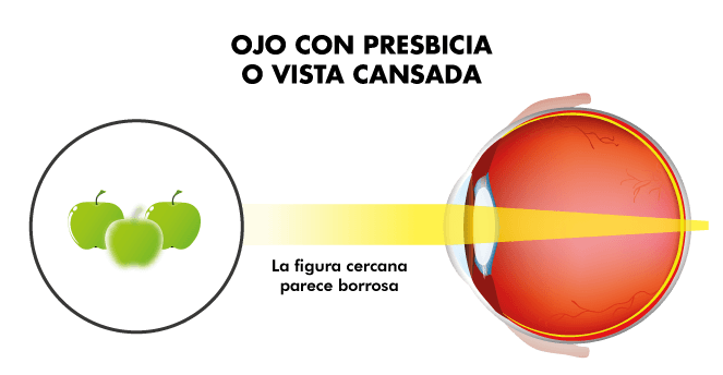 Operación de presbicia o vista cantada | IOTT | Oftalmología